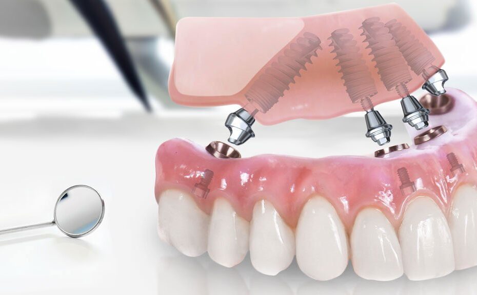 Технология All-on-4