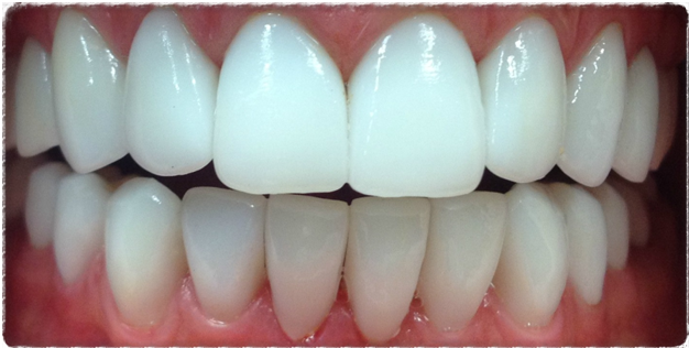 Циркониевые коронки