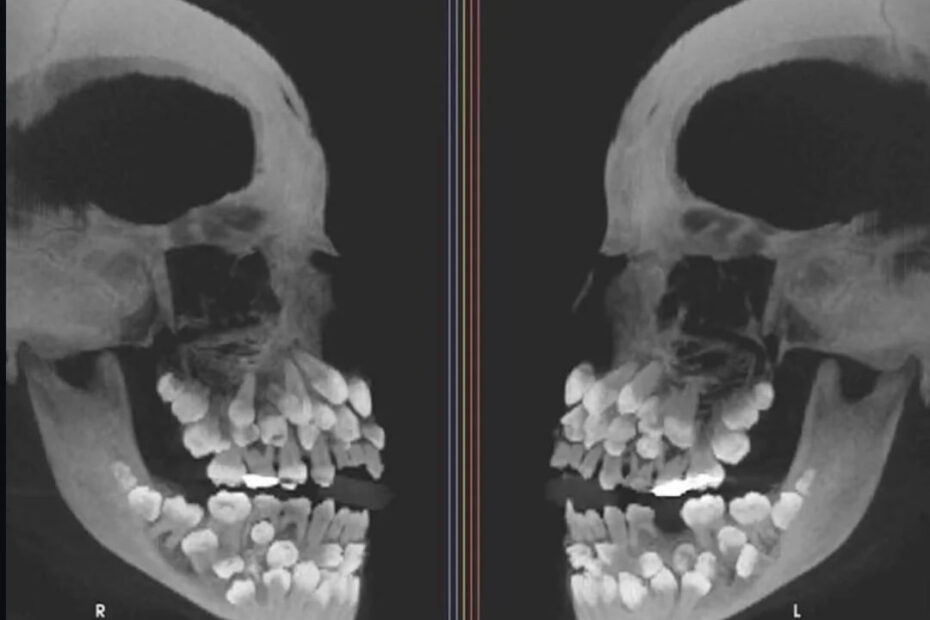 Гипердонтия